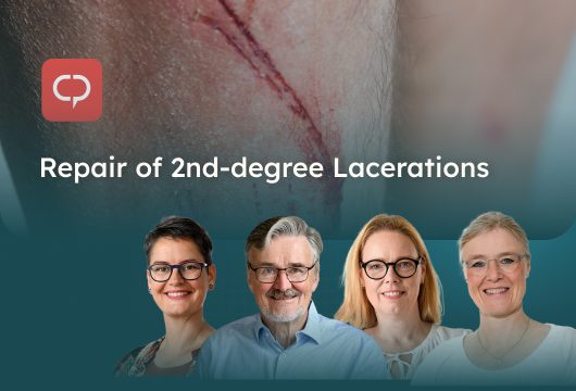 Repair of 2nd-degree Lacerations_2